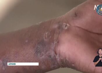 Вирус оспы обезьян бушует в странах Африки