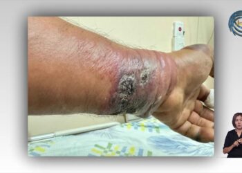 Алматы облысындағы 4 азамат Сібір жарасын жұқтырған болуы мүмкін